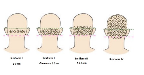 Acne_keloidalis_nuchae_akne_keloidalis_nusa_ensede_akne_siniflama.jpg