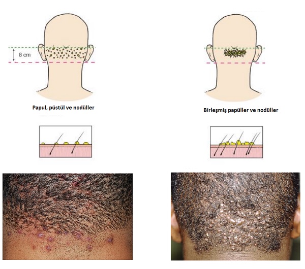 Acne_keloidalis_nuchae_akne_keloidalis_nusa_ensede_akne_siniflama2.jpg