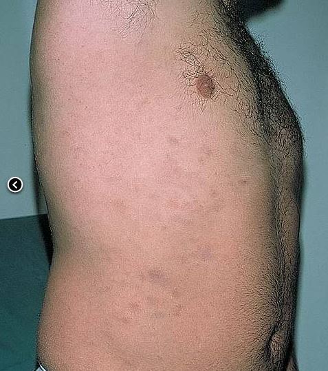 Ashy-Dermatozis-2.jpg