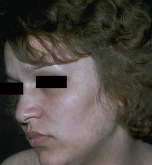 Ashy-Dermatozis.jpg