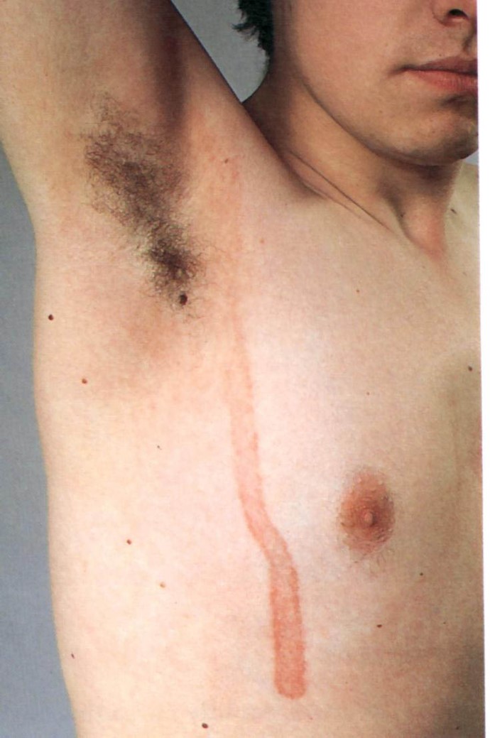 Berloque-Dermatitis-3.jpg