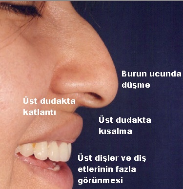 Botox-ile-burun-estetigi-3.jpg
