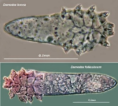 Demodikozis-Pitriazis-follikulorum-3.jpg