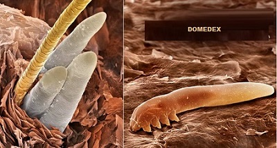 Demodikozis-Pitriazis-follikulorum.jpg