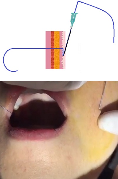 Yanak Gamzesi, Gülme gamzesi, Cheek Dimple, Uygulaması, Dimpleplasty