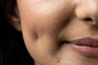 Yanak Gamzesi, Gülme gamzesi, Cheek Dimple, Uygulaması, Dimpleplasty