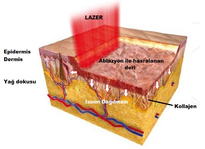 Fraksiyonel-CO2-lazer-Klasik-CO2-lazer-1.jpg