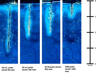 Fraksiyonle-CO2-lazer-pulse-sresi.jpg