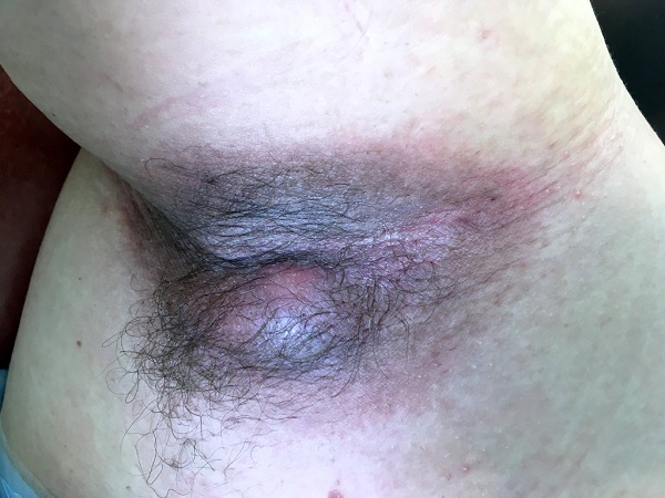 Hidradenitis_Supurativakopek_memesi_hastaligi.jpg