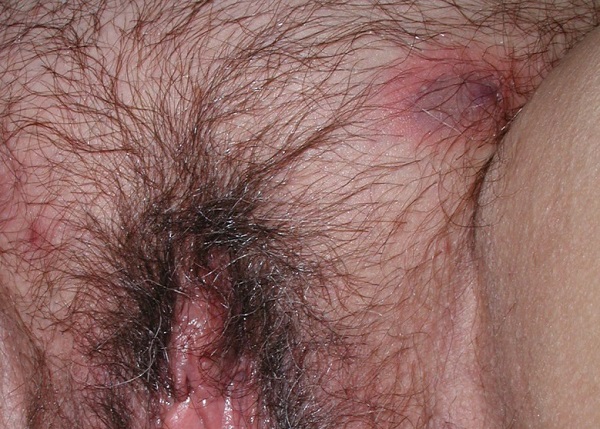 Hidradenitis_Supurativakopek_memesi_hastaligi_abseler.jpg