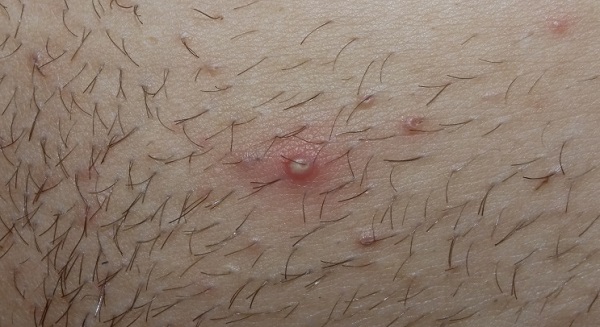 Hidradenitis_Supurativakopek_memesi_hastaligi_pustuller.jpg