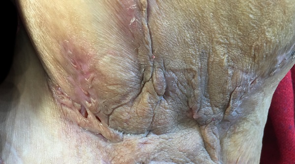 Hidradenitis_Supurativakopek_memesi_hastaligi_sinus_fistul_tract_2.jpg