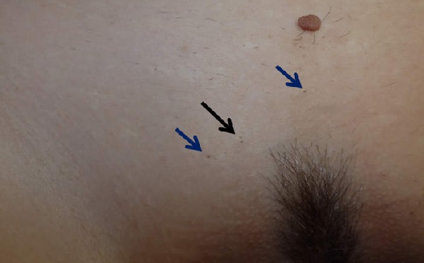 Hidradenitis_Supurativakopek_memesi_hastaligikomedonlar.jpg