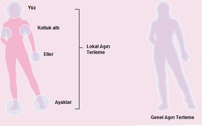 Hiperhidrozis-Lokal-ve-genel-hiperhidroizis.jpg