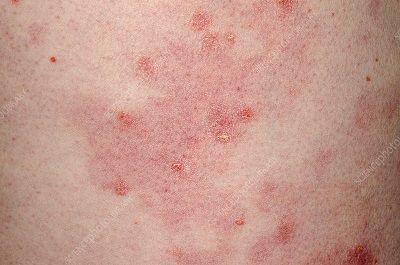 Lityum-ve-psoriasis.jpg