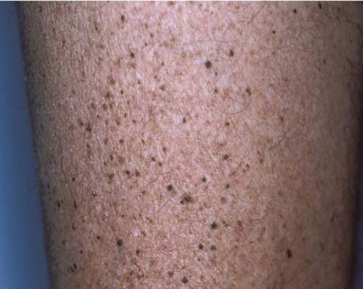 Melanositik-nevs-lentigo-tipi.jpg