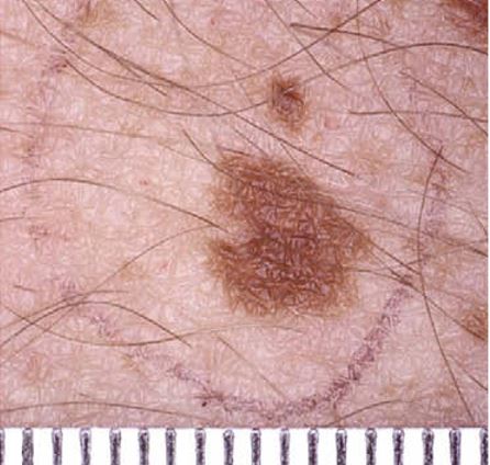 Melanositik-nevs-perifollikler-hipopigmentasyon-tipi.jpg