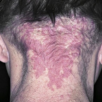 Nevus-flammeus-nuchae-Leylek-sr.jpg