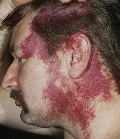 Porto-Sarab-Lekesi-Port-Wein-Stain-Nevus-Flammeus-66.jpg