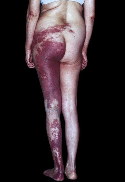 Porto-Sarab-Lekesi-Port-Wein-Stain-Nevus-Flammeus-77.jpg