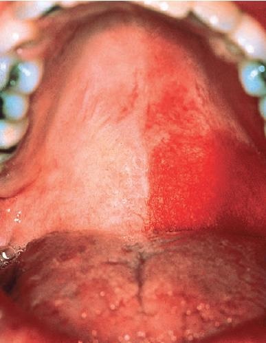 Porto-Sarab-Lekesi-Port-Wein-Stain-Nevus-Flammeus-Mukozal.jpg
