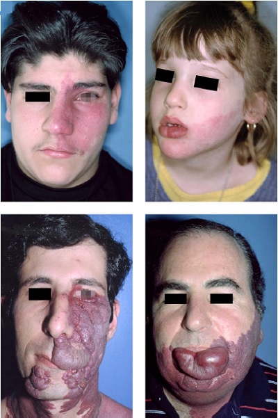 Porto-Sarab-Lekesi-Port-Wein-Stain-Nevus-Flammeus.jpg