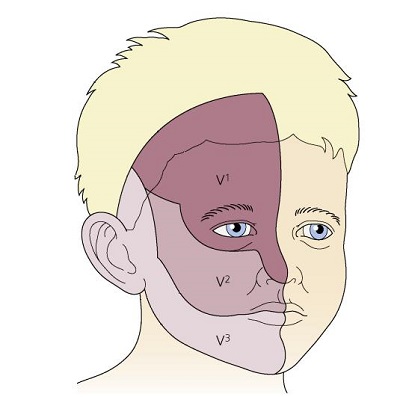 Porto-arab-Lekesi-Port-Wein-Stain-Nevus-Flammeus-trigeminal-sinir-dalm.jpg