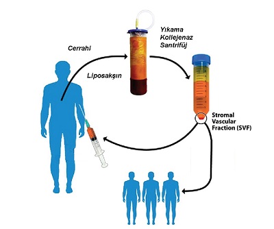 Yağ Dokusunun Yenileyici ve Onarıcı Hücre Kaynağı, Adipos Derived Stromal Vascular Fraction (AD-SVF)