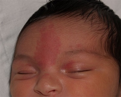 Salmon-patch-Nevus-flammeus-neonetarum.jpg