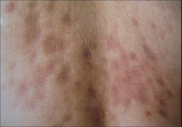 Lokalize skleroderma, Morfea, Morphea