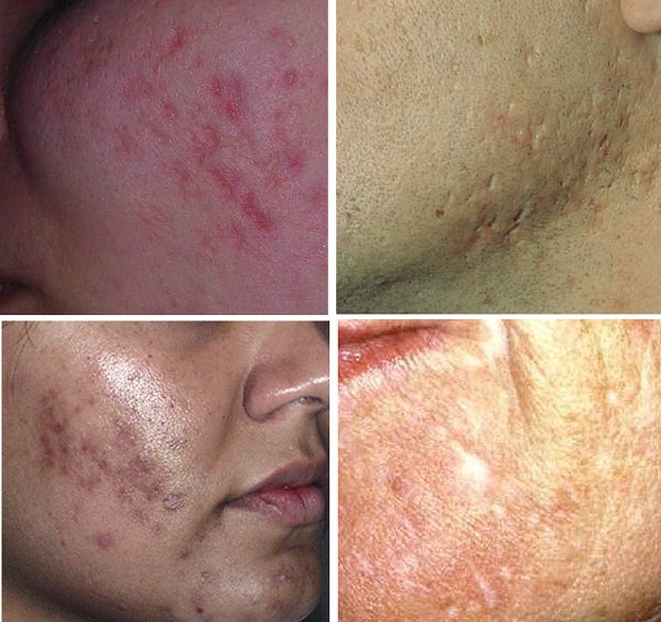 Skar-keloid-4.jpg