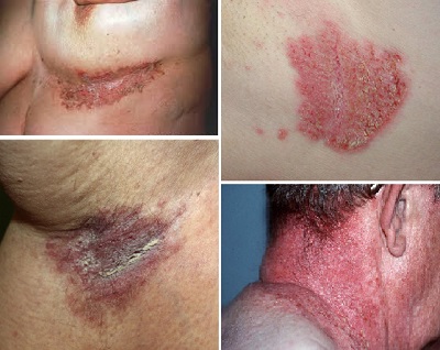 Hailey-Hailey Hastalığında Lazer Tedavileri