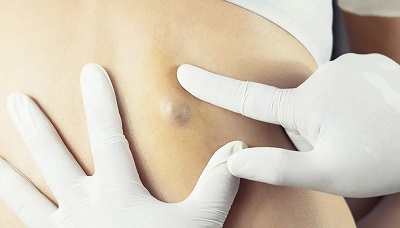  Epidermoid Kist, Sebase Kist, Pilar Kist 