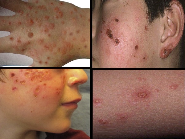 Hidroa vaksiniforme hastalığı, Hydroa vacciniforme