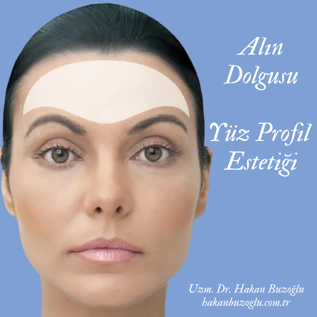 Alın Dolgu Uygulaması Hyaluronik Asit 