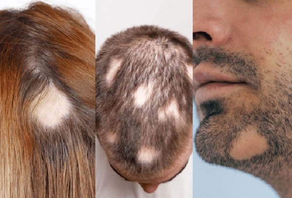 Alopesia Areata Saç Kıran Hastalığı Tedavisinde Güncel Prensipler