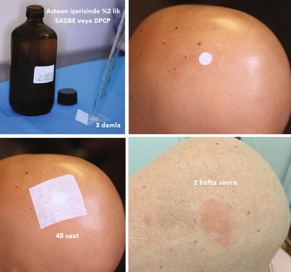 Alopesi Areata Tedavisinde Topikal Duyarlandırıcılar, Temas İmmünoterapi