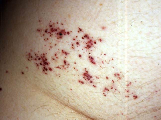 angioma_serpiginosum_02.jpg