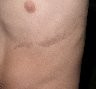 atrofoderma_linear_atrofoderma_Moulinin_atrofodermas.jpg