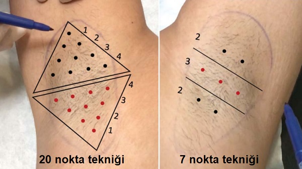 Koltuk Altı Aşırı Terleme Botoks(Botulinum Toksin) Uygulaması 7 Nokta Tekniği