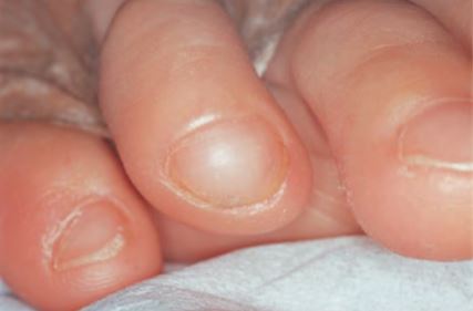 ayak-4.-trnakta-izole-parrot-beak-nail.jpg