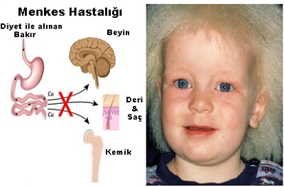 bakr-ve-menkes-hastaligi.jpg