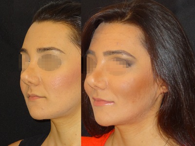 Bişektomi, Bukkal Yağ Yastığı, Bichectomy, Buccal Fat Pad