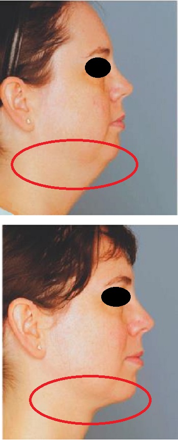 boyun-estetii-boyun-germe-ipliklerle-boyun-germe.jpg