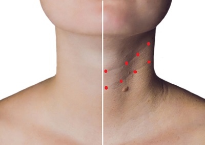 boyun-kirisikliklari-botox-3.jpg
