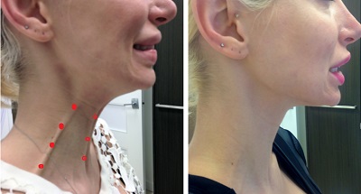 boyun-platysma-bantlar-botox-3.jpg