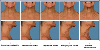 boyun-platysmal-bant-botox-5.jpg