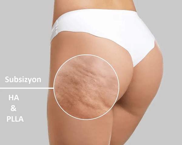 Kalça(Basen) Selülit Dimple Problemlerinde Subsizyon ve Dolgu Uygulaması 
