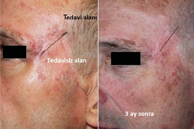 cerrahi_sonrasi_iz_skar_fraksiyonel_co2_lazer_tedavisi.jpg