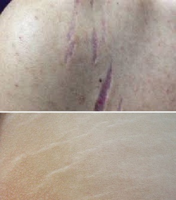cilt-deri-catlaklarinda-kimyasal-peeling.jpg